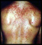 acne1.jpg